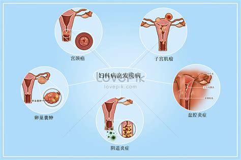 婦科 病